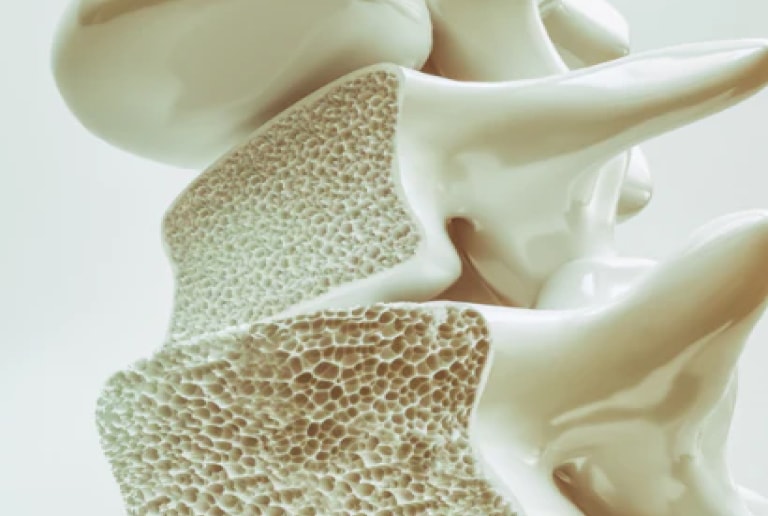 Check up osteoporosi - Laboratorio Analisi Trastevere